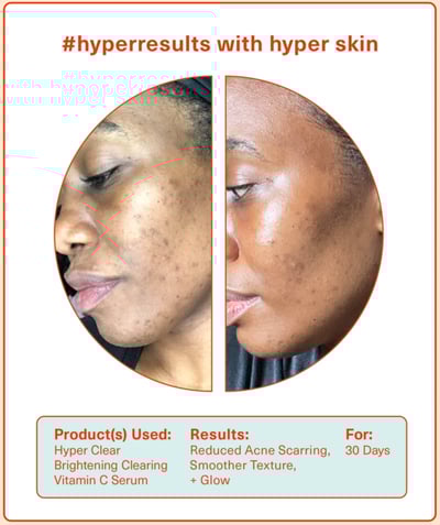 HyperResults